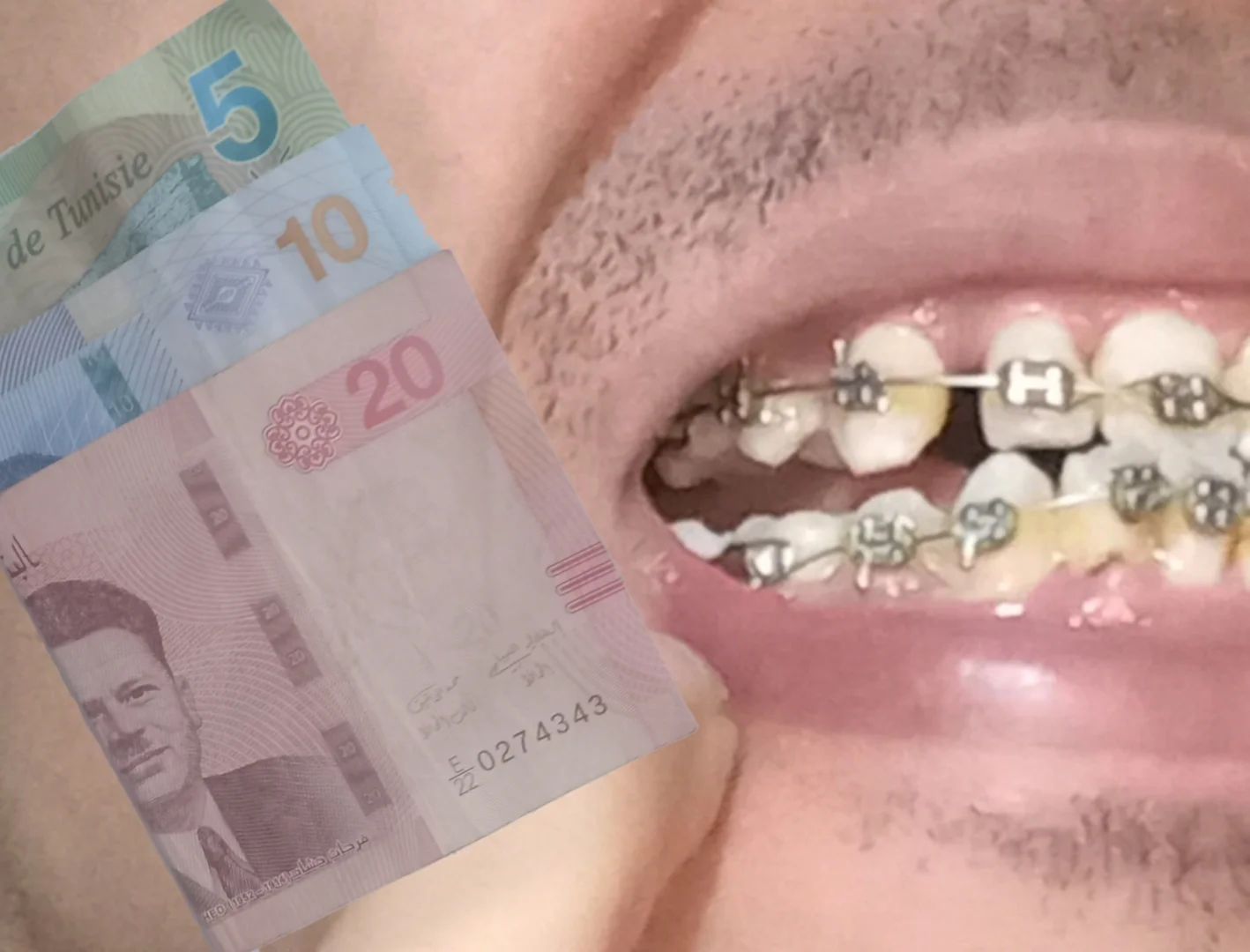 سعر تقويم الأسنان في تونس بالدينار