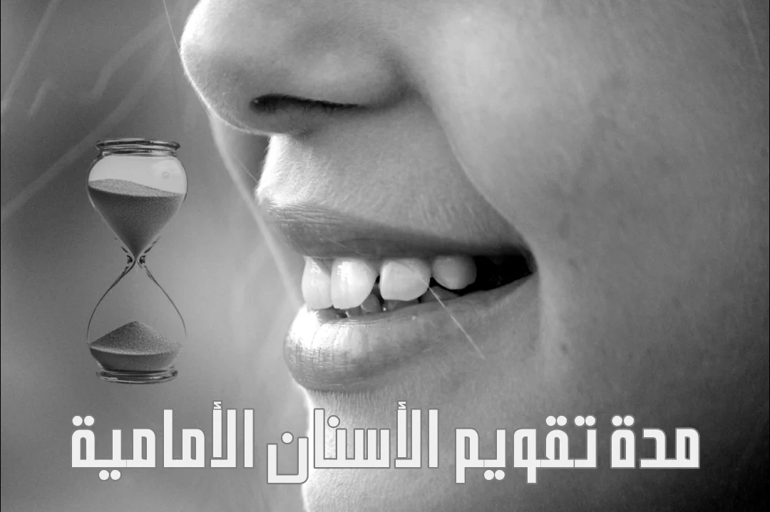 كم مدة تقويم الأسنان الأمامية