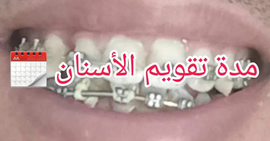مدة تقويم الأسنان في تونس