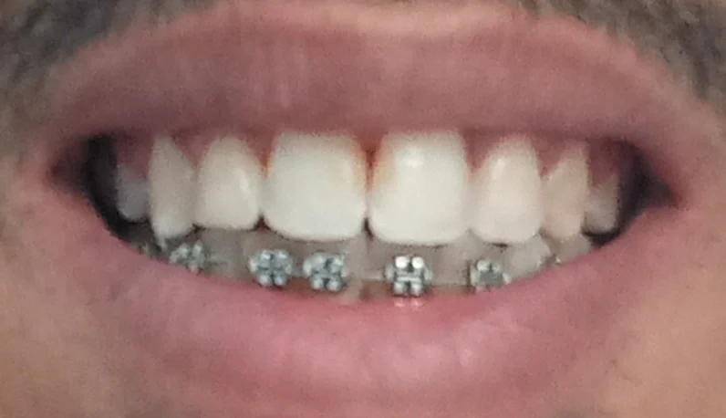 Prix appareil dentaire Tunisie